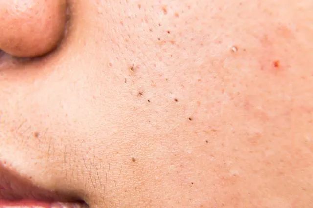 黑頭是怎么形成的？如何預(yù)防黑頭的產(chǎn)生？